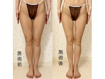 ルルアス(LuLuAS)/脚インディバ