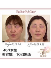 瑞 鍼灸院/ビフォーアフター美容鍼