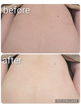 フェローズリンパケア(FELLOWS)/背中ピーリング