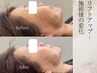 【エラの張り・頬の厚みに】頬をダブル照射!!小顔改善リフトアップ11800