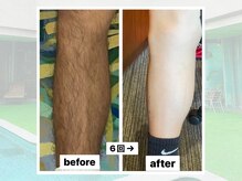 ベルゼ 渋谷店(BELZE)/男性全身脱毛!6回で驚きの効果☆