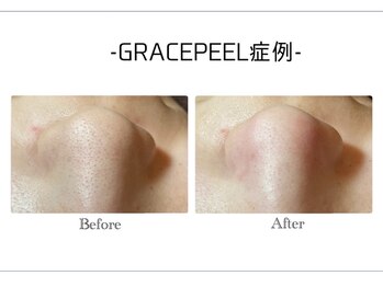 ピュールマロン ムッシュタロウ 桑名店(Pure Marron M.Taro)/毛穴洗浄1位獲得の施術