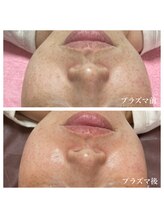 キラ(KIRA)/気になるシミにもアプローチ！