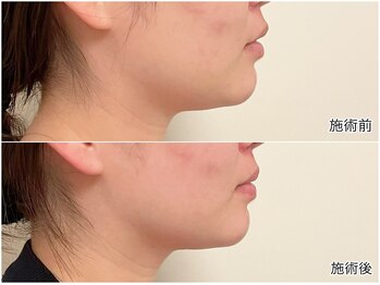 エムベル(M.belle)/リフトアップマッサージ技術前後