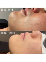 イエナ(IENA)/毎回ポロポロ抜ける感動ヒゲ脱毛