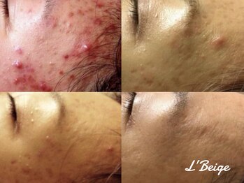 レ ベージュ(L’Beige)/リアボーテ肌質改善フェイシャル