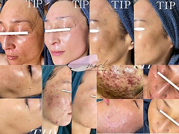 ミエル(miel)/シミケア・ハーブピーリング症例