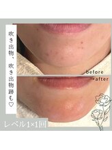 ジプソフィラフィフティドット(gypsophira15.)/ハーブピーリング