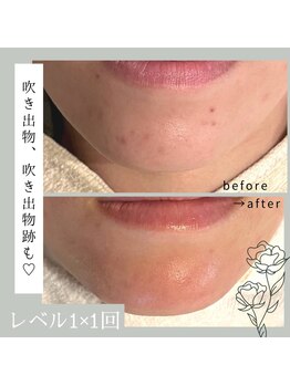 ジプソフィラフィフティドット(gypsophira15.)/ハーブピーリング