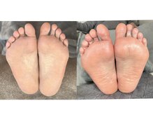 キレイネイル 竹の塚/フットかかと角質ケア