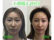 オズ六本木/小顔矯正モニター2回目施術