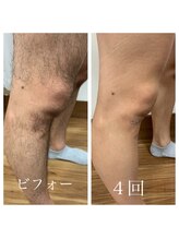 リアンジュ/足脱毛の経過