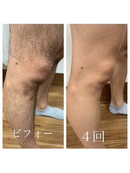 リアンジュ/足脱毛の経過