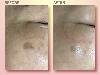 ジュリア オージェ 京橋店/ビフォーアフター(シミケアP)