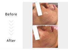 アブニールブリヨン/ハーブピーリング　Before After