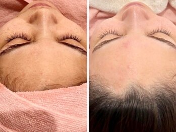 アンジープラス(ANZY+)の写真/【今すぐ！お肌を綺麗にしたい時】はフェイシャルWAX脱毛！産毛や毛穴汚れを取り除き、艶肌トーンアップ！