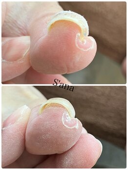 サナ 久が原 千鳥町(S’ana)/巻き爪ケアして
