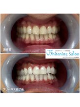 ホワイトニングサロン 名古屋駅店/【ホワイトニング施術例】