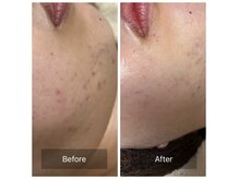 ハーブピーリングによるニキビケア◎美白効果も抜群★