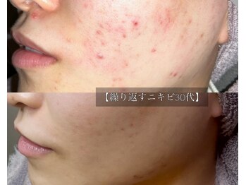 ル シーニュ/プロセルフェイシャル×4回