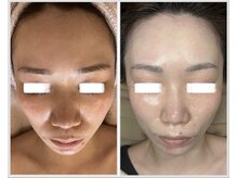 美しぐれ 溝の口/【4回】LDM/インモード/MTS