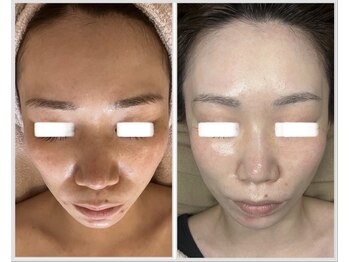 美しぐれ 溝の口/【4回】LDM/インモード/MTS