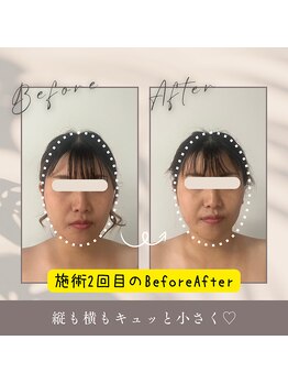 リル(LIL)の写真/【痛みの少ない優しい施術の小顔調整★】効果実感でリピート多数！あなたの理想のフェイスラインに◎