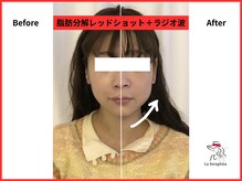 ラ セラフィータ 中目黒/レッドショット＋ラジオ波