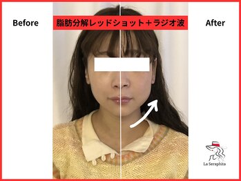 ラ セラフィータ 中目黒/レッドショット＋ラジオ波