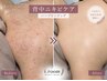 ★【背中上部】陶肌トリートメント/ハーブピーリングOP1つプレゼント