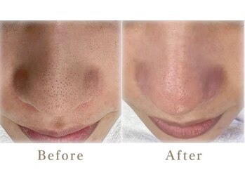 デェア コミータ/ハイドロフェイシャル