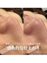 リモナ(Re-mona..)/REVIハーブピーリング×毛穴洗浄