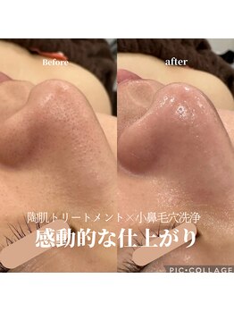 リモナ(Re-mona..)/REVIハーブピーリング×毛穴洗浄