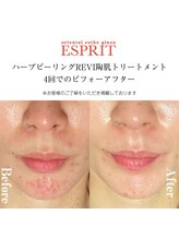 エスプリ 銀座店/ハーブピーリングREVI陶肌