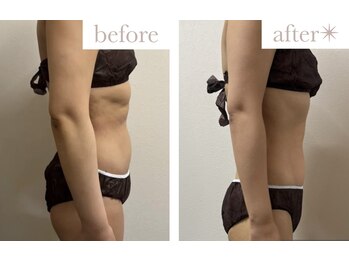 エバーグリーン(Evergreen)/脂肪冷却7回の変化