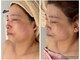 リンダ(Rinda)の写真/フォースカッター×最新韓国肌管理"レッドショット即小顔!即効性◎トリートメントと同時施術体験可能◎