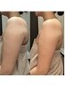 【再来】【脂肪分解導入×グロッティ痩身】気になる部分の脂肪を集中撃退！！