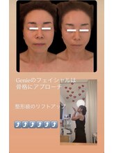 ジーニー(Genie)/骨からリフトアップ！
