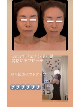 ジーニー(Genie)/骨からリフトアップ！