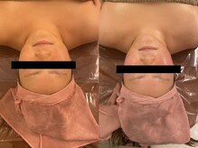 サロン ドゥ レーベル(Salon de Label)/コルギで血流をよくする！！