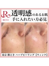 ウィンク 勝どき(wink)/ハーブピーリング