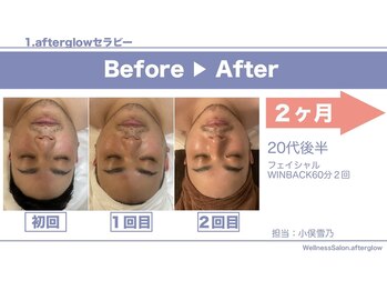 アフターグロウ(afterglow)/メンズフェイシャル