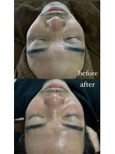 キュル(Kyul)/REVIハーブピーリング