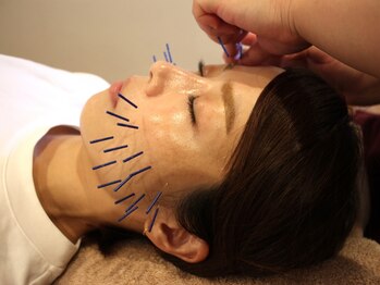 ビープラス(BEE PLUS)/美容鍼・小顔矯正