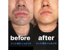 メンズ脱毛 ジョルジオ(GIORGIO)