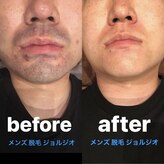 メンズ脱毛 ジョルジオ(GIORGIO)