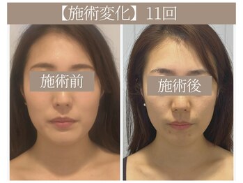 ドクターボディ 恵比寿店(Dr.Body)/【頬たるみ/むくみ/長さ 30代】