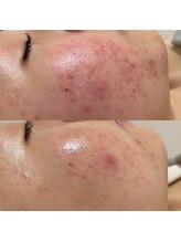 エルエーズ(Elleaise)/たった1回ケアで肌質改善！