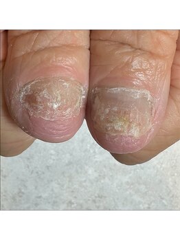 イデアル(ide’al)の写真/深爪・トラブル爪・剥離、凹凸などのあらゆるトラブル爪に対応◎お気軽にご相談ください♪
