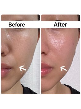 バイオ スキン プラス(Bio Skin Plus)/レモンボトルでほうれい線改善